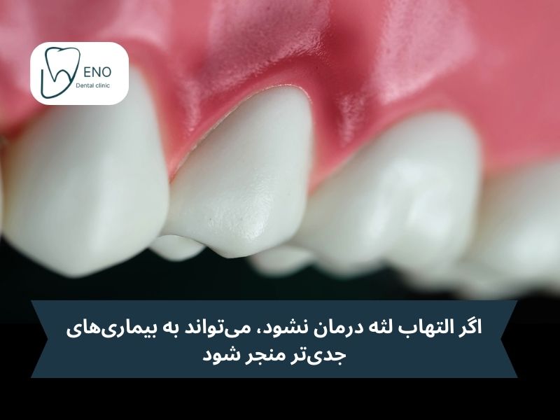 آیا التهاب لثه میتواند به مشکلات جدیتری منجر شود