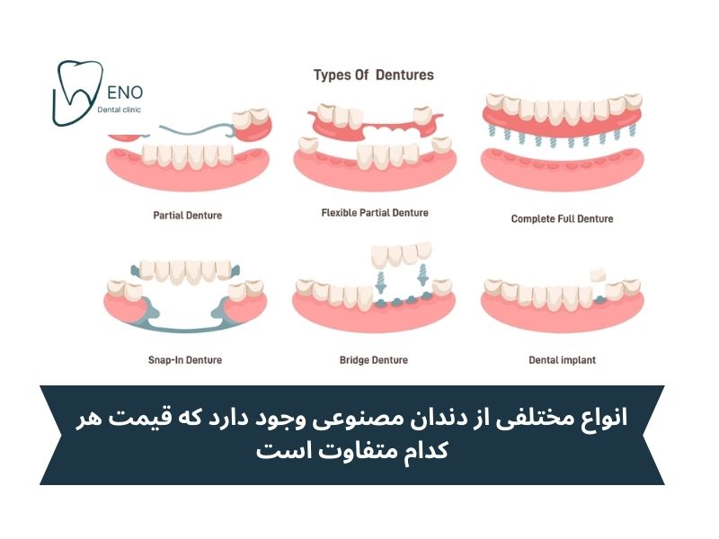 انواع دندان مصنوعی و قیمت