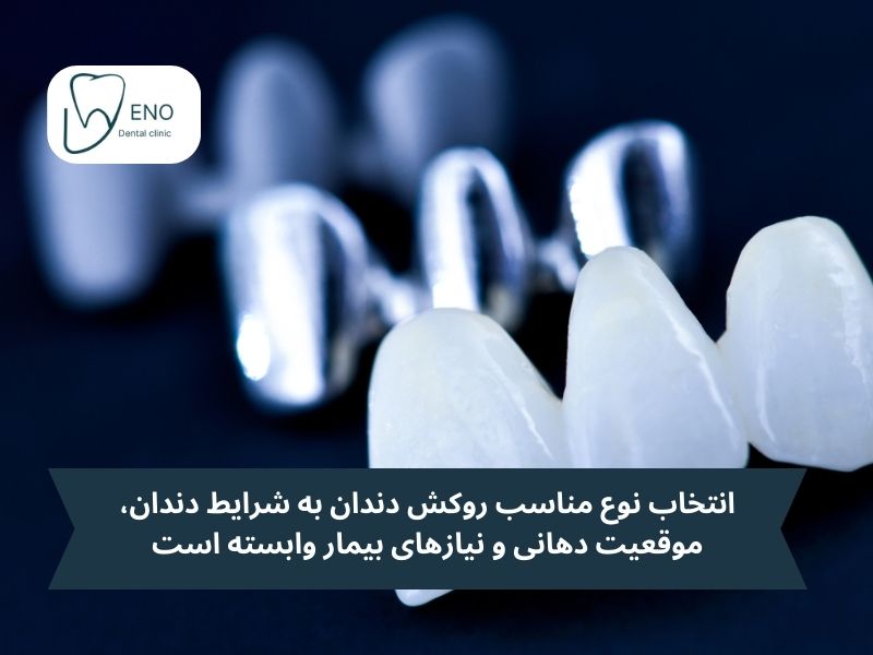 انواع روکش دندان
