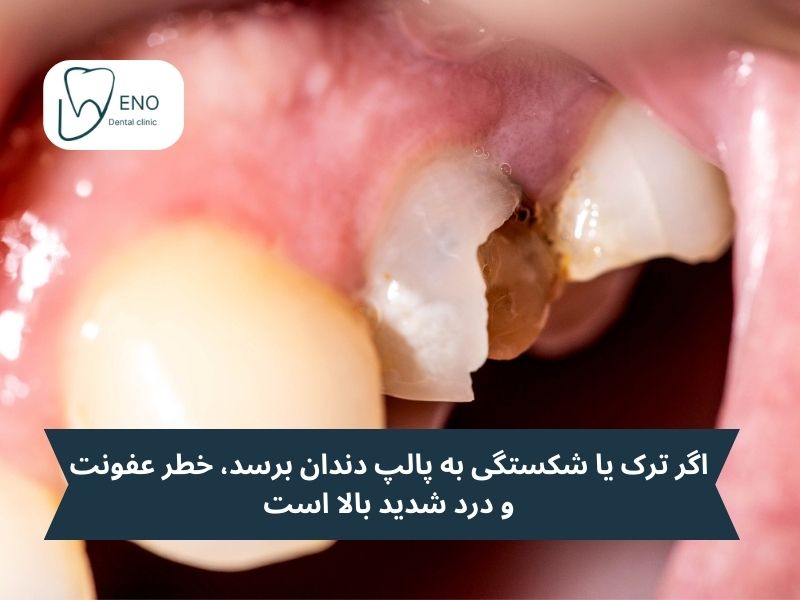 اگر ترک یا شکستگی به این بخش برسد، خطر عفونت و درد شدید بالا است
