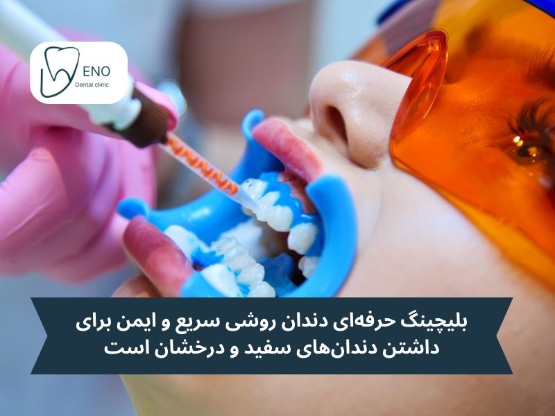 بلیچینگ حرفهای در کلینیک دندانپزشکی؛ قویترین روش بلیچینگ دندان