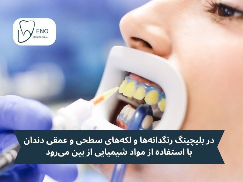 بلیچینگ دندان چیست و چرا اهمیت دارد؟