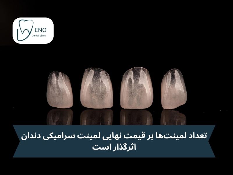 تعداد لمینت مورد نیاز و تاثیرش بر قیمت نهایی