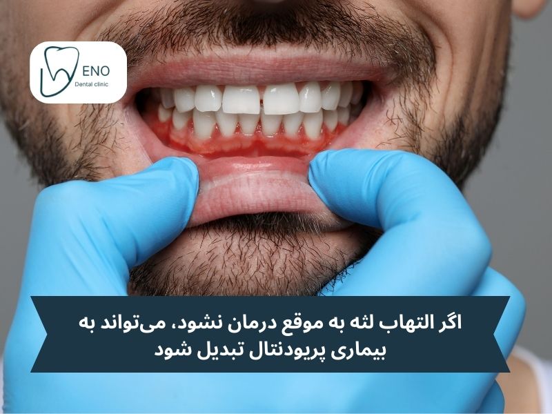 تفاوت بین التهاب لثه و بیماری پریودنتال