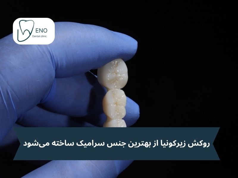 روکش زیرکونیا