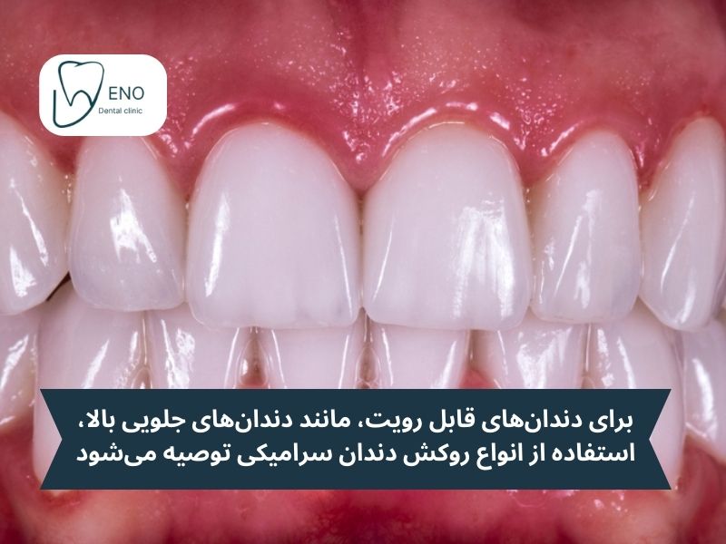 روکش سرامیکی دندان