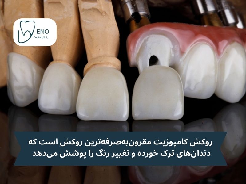 روکش کامپوزیت دندان