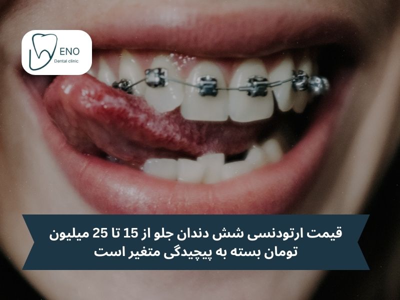 قیمت ارتودنسی دندان های جلو