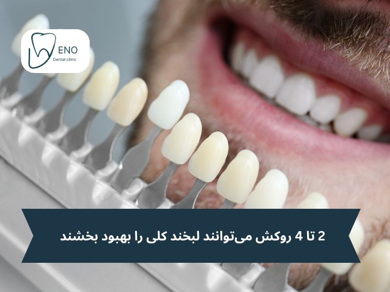 من به چند واحد لمینت نیاز دارم؟ آشنایی با انواع اصلاح لبخند