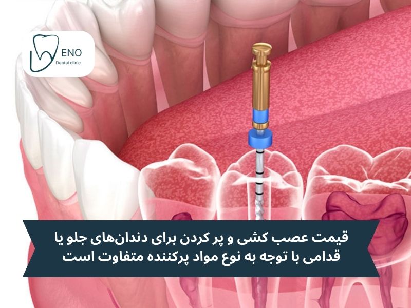 هزینه عصب کشی و پر کردن دندان