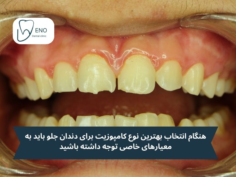 ویژگیهای بهترین مارک کامپوزیت دندان برای دندانهای جلو
