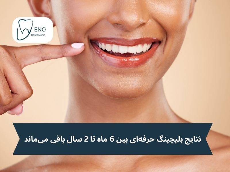 چقدر طول میکشد تا اثر بلیچینگ از بین برود؟