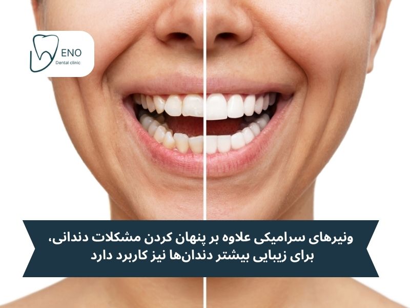 کاربرد روکش دندان سرامیکی