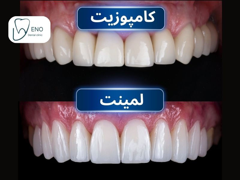 فرق لمینت و کامپوزیت دندان