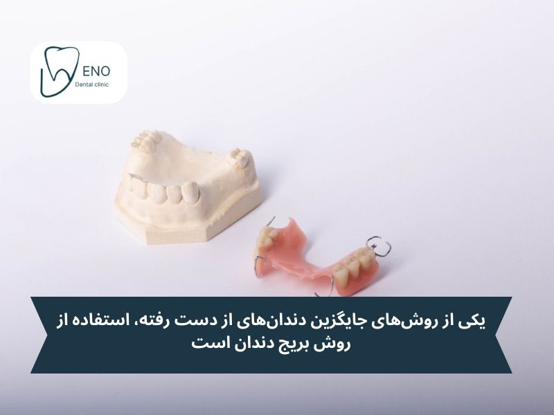 بریج دندانی؛ پلی برای پر کردن جای خالی دندان