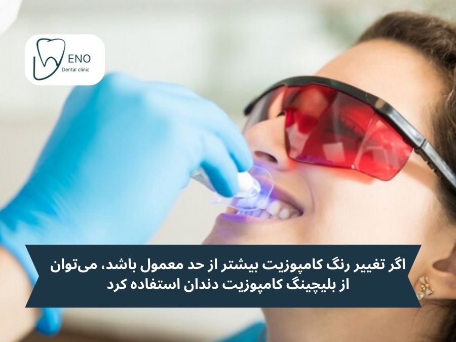 بلیچینگ کامپوزیت؛ استفاده از مواد سفیدکننده مخصوص کامپوزیت