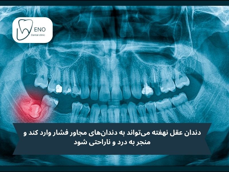 دندان عقل نهفته