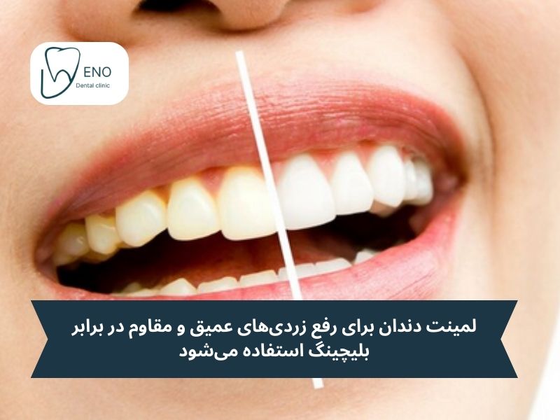 رهایی قطعی از زردی دندان با درمانهای تخصصی