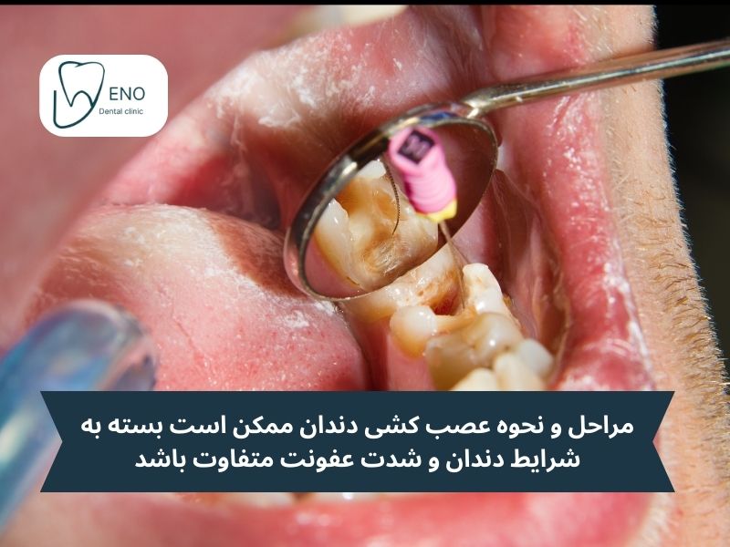 هزینههای عصب کشی دندان چقدر است