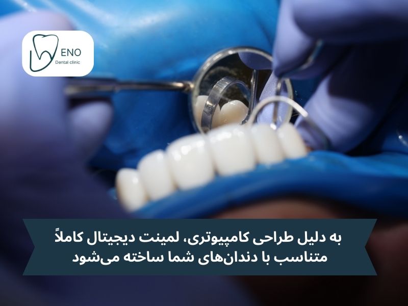 آیا لمینت دیجیتال بهترین لمینت دندان است؟