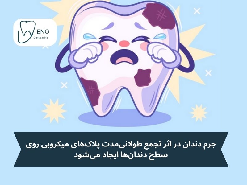 جرم دندان چیست