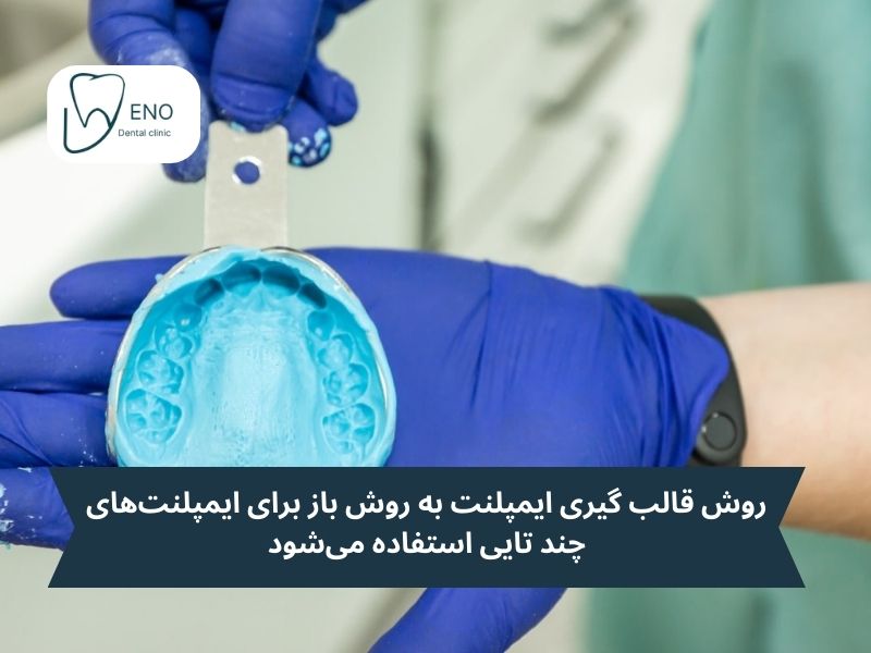 روش قالب گیری ایمپلنت به روش باز