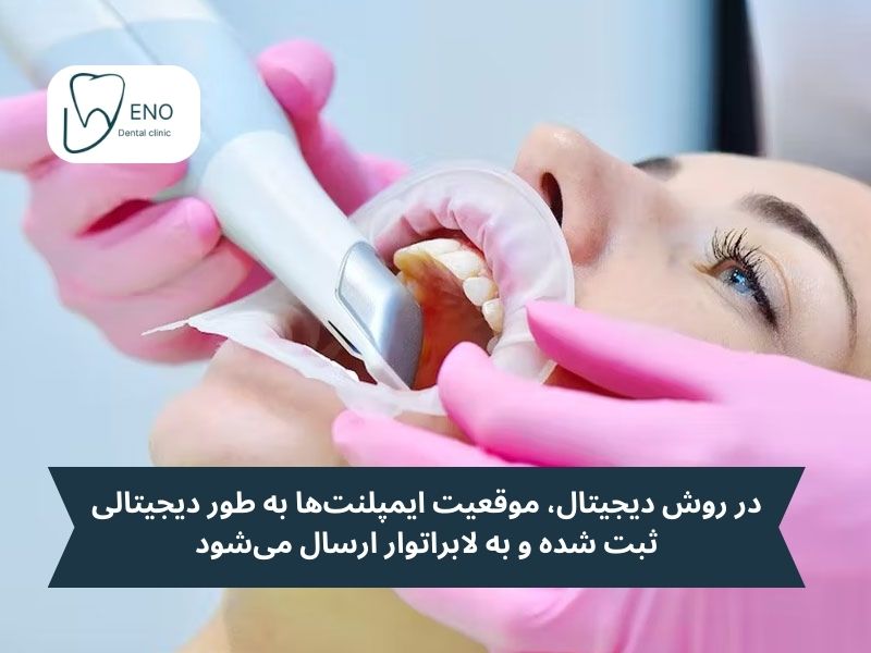 روش قالب گیری پروتز ایمپلنت دیجیتال