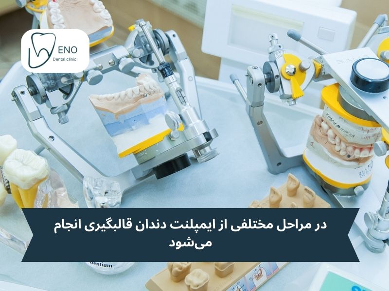 قالب گیری ایمپلنت چند مرحله دارد