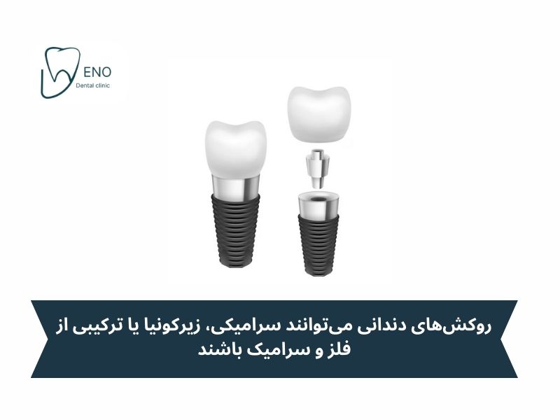 مراحل کاشت ایمپلنت آلمانی؛ از ابتدا تا پایان