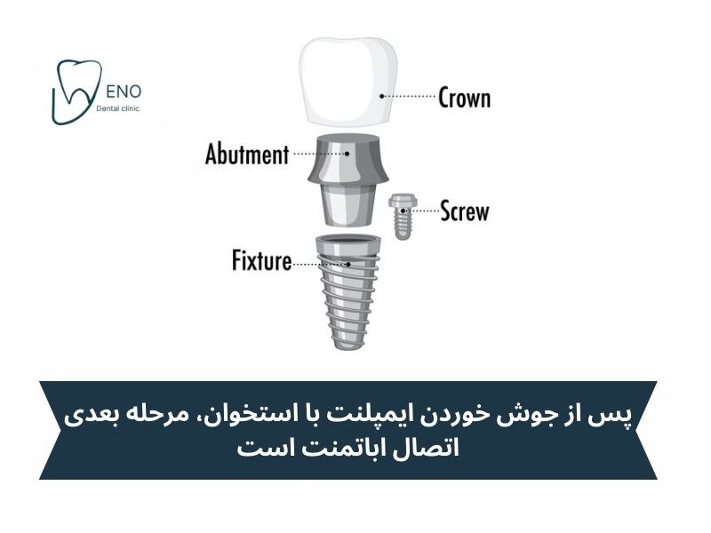 مرحله پنجم: اتصال اباتمنت (Abutment)
