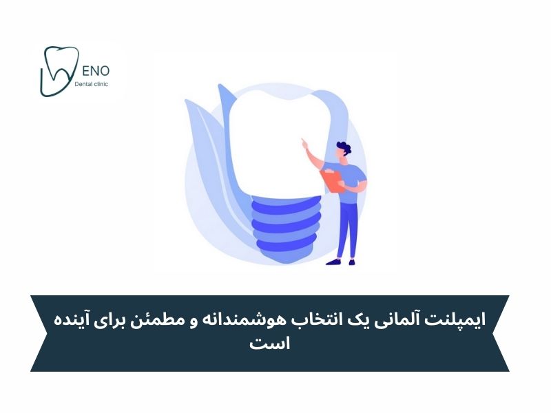 مزایا و معایب ایمپلنت آلمانی چیست