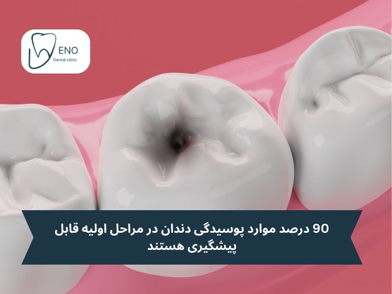 چرا تشخیص پوسیدگی دندان در خانه اهمیت دارد؟
