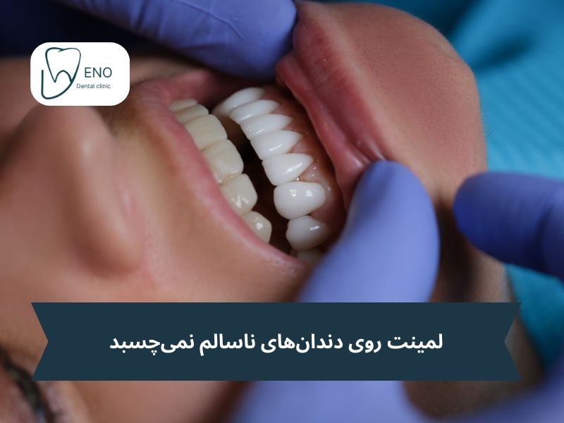 چه کسانی نباید لمینت دندان انجام دهند