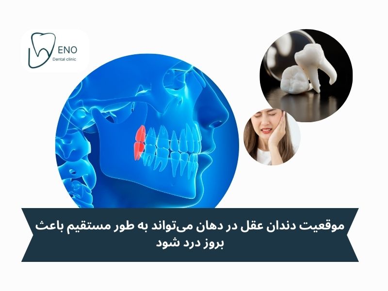 موقعیت دندان عقل در دهان