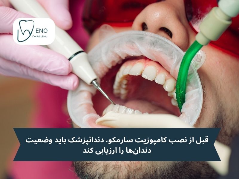پیش از نصب سارمکو