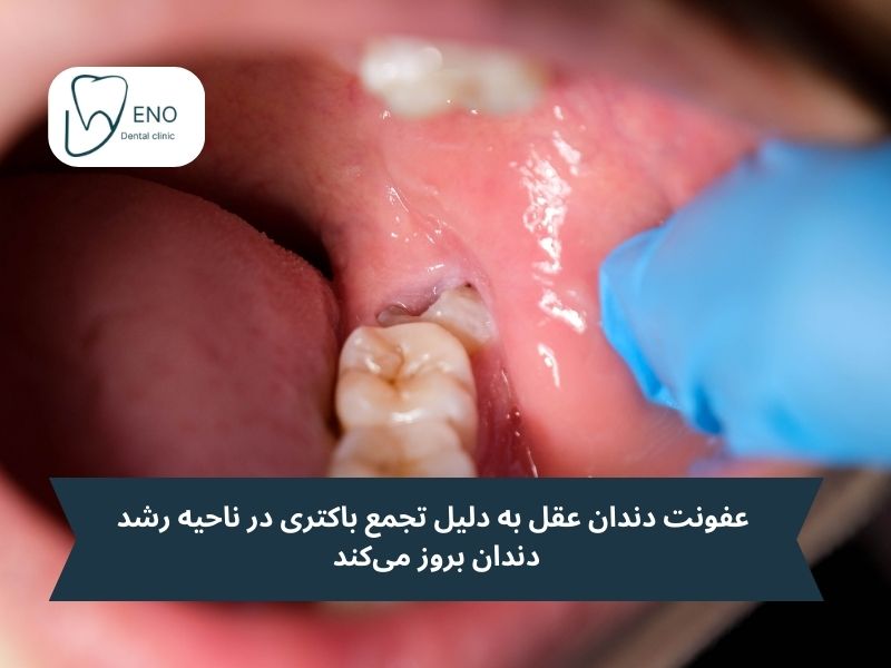 عفونت دندان عقل