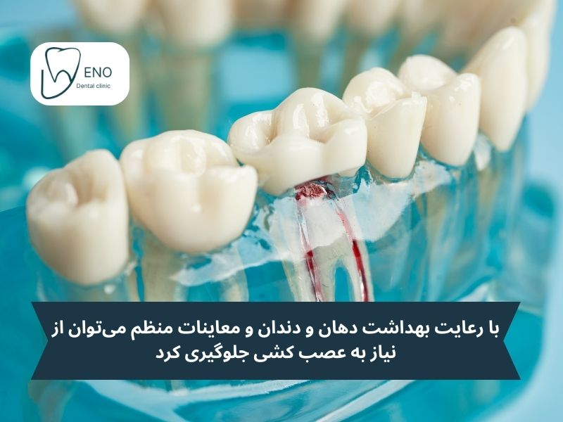 جلوگیری از عصب کشی