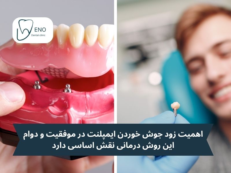 زود جوش خوردن ایمپلنت
