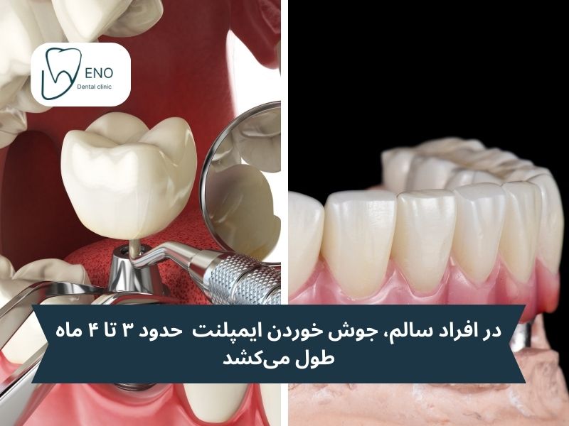 مراحل جوش خوردن ایمپلنت