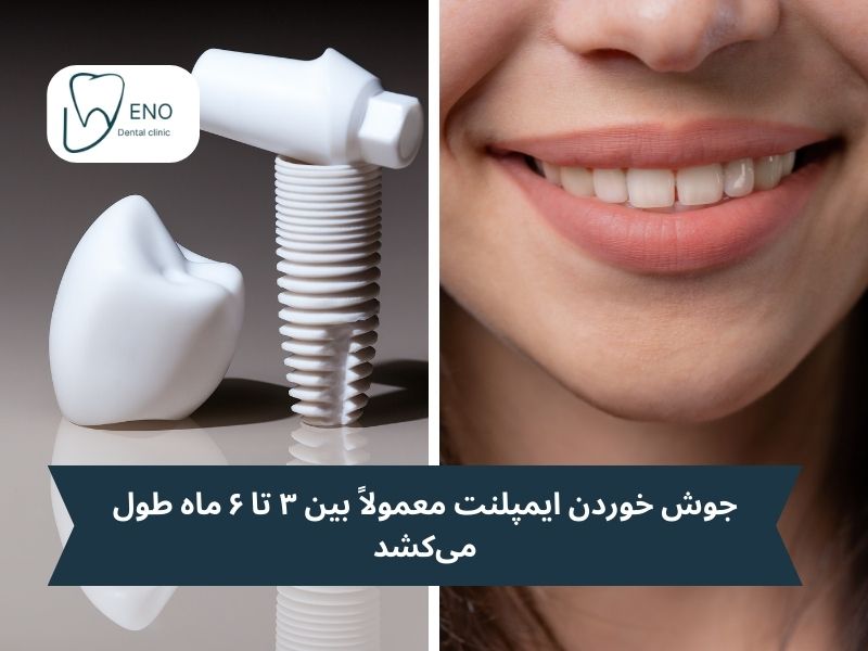 زمان جوش خوردن ایمپلنت
