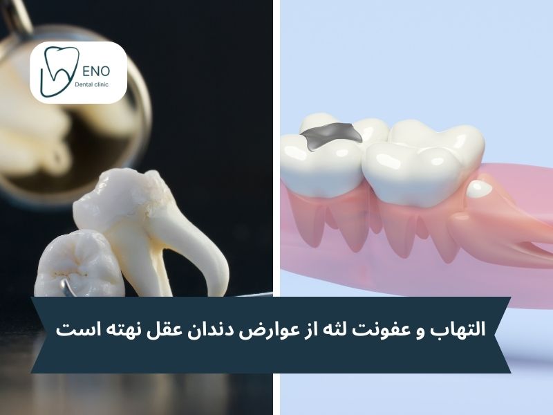 عوارض دندان عقل نهفته