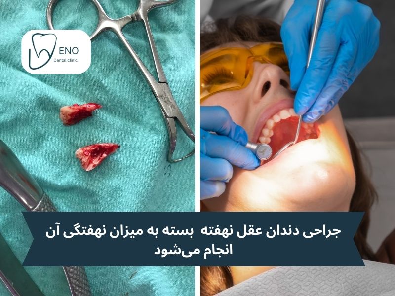 جراحی دندان عقل نهفته یک روش درمانی تخصصی است که بسته به موقعیت دندان و میزان نهفتگی آن انجام میشود