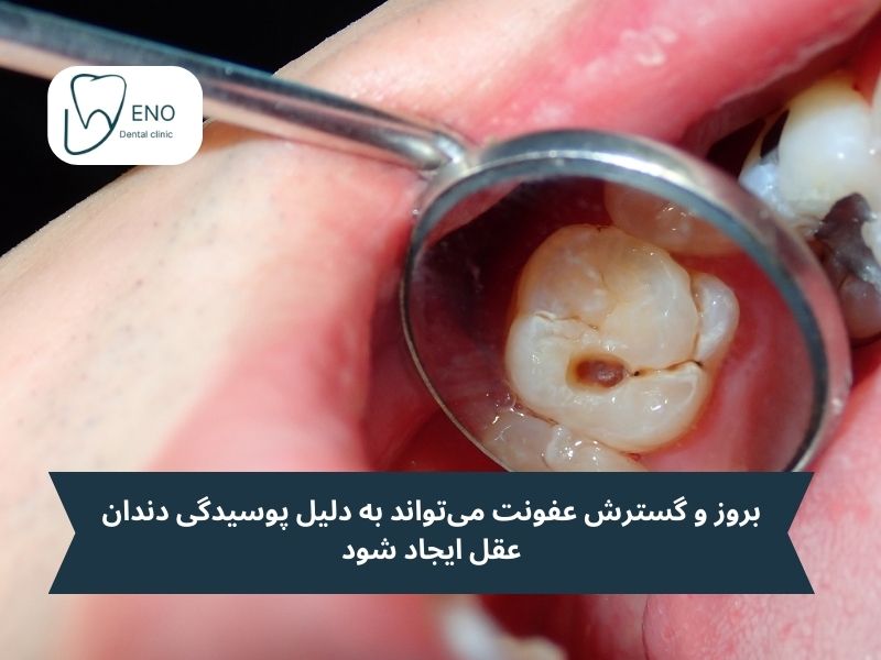 درمان عفونت دندان عقل