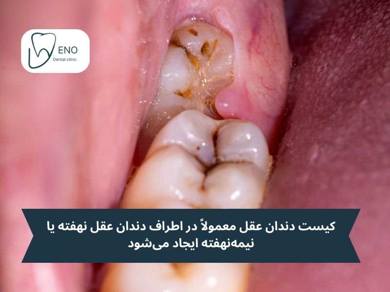 راه درمان کیست یا تومور دندان عقل