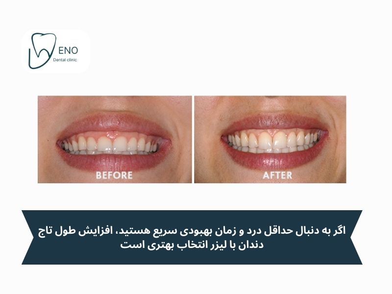 بهترین روش برای افزایش طول تاج دندان چیست