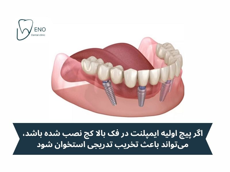 تحلیل استخوان اطراف ایمپلنت؛ از چالشهای اصلی در کاشت ایمپلنت