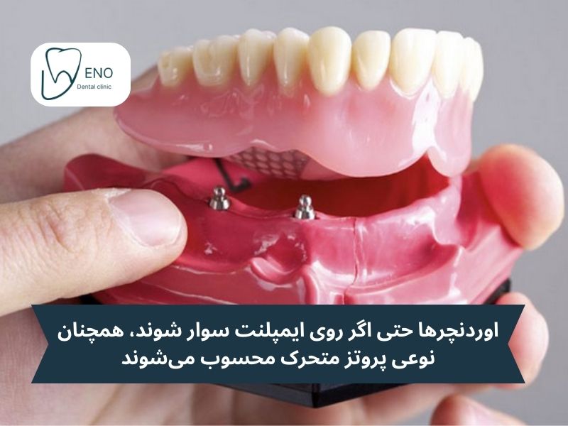 فرق اوردنچر با ایمپلنت از نظر میزان راحتی و طبیعی بودن