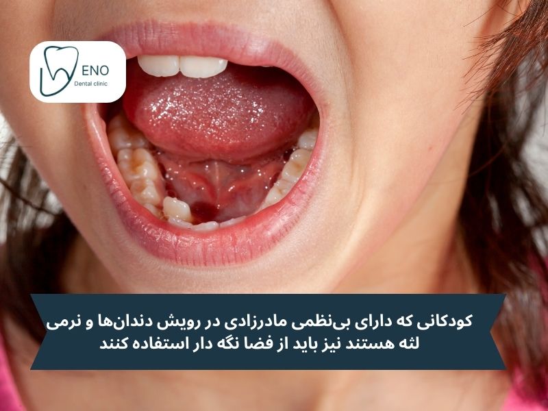 کودکانی که دارای بینظمی مادرزادی در رویش دندانها و نرمی لثه هستند نیز باید از فضا نگه دار استفاده کنند