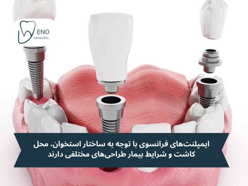 ایمپلنتهای فرانسوی با توجه به ساختار استخوان، محل کاشت و شرایط بیمار طراحیهای مختلفی دارند
