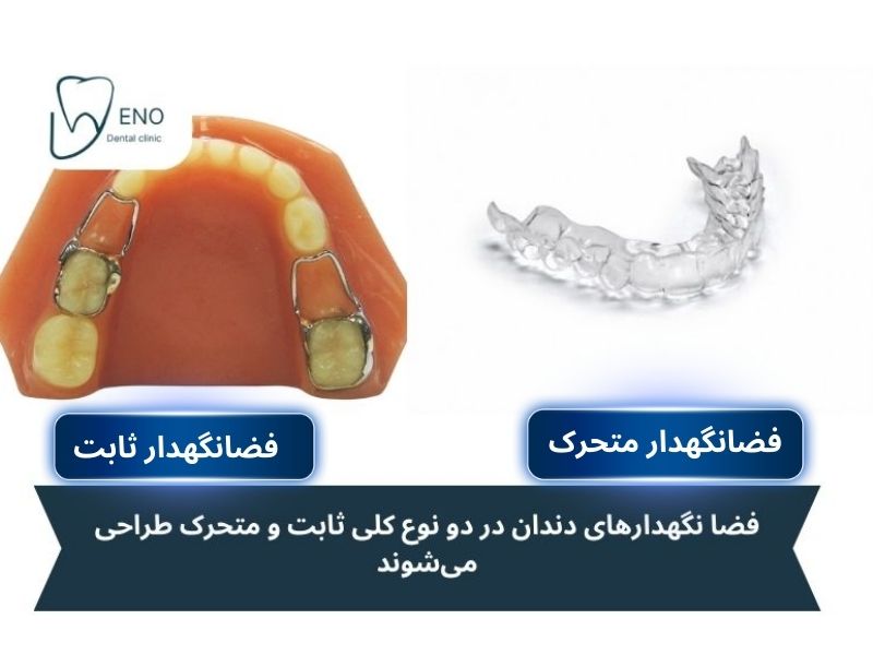 انواع فضا نگهدار دندان